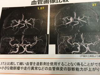 脳卒中に備えて、解像度の高い３．０テスラのＭＲＩで検査